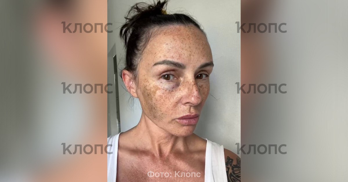 В Зеленоградске женщину выгнали из кафе и ударили в лицо — версии пострадавшей и заведения