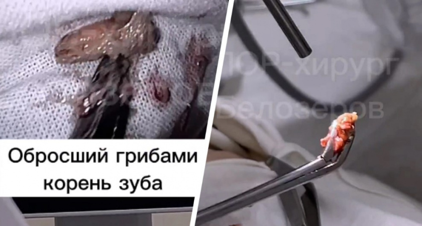 Врачи из Нижнего Новгорода обнаружили и удалили корень зуба, который застрял в носу пациентки