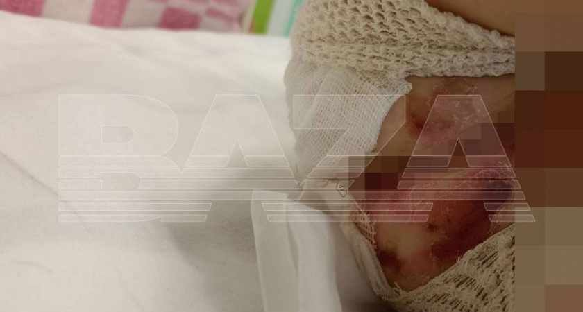 В детском саду в Ярославской области трехлетний малыш получил серьезные ожоги