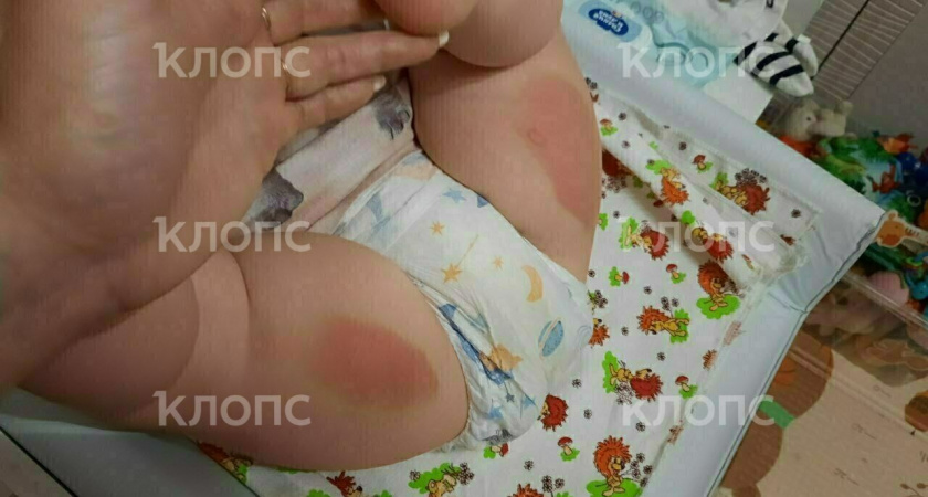 «Кислотой пропитался плед» на Балтийской косе произошло ЧП: Там маленькая девочка едва не погубила годовалого ребенка 