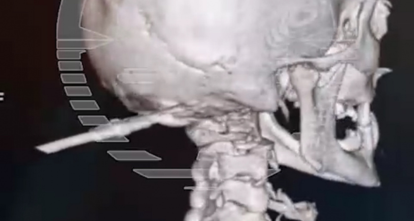 Вкрутил мозги в прямом смысле слова. Что произошло с мужчиной из Башкирии? (ВИДЕО 18+) 