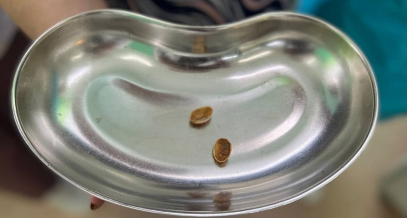 «Больше года ходила с этим» Как всего лишь одна фисташка чуть не убила жительницу Подмосковья