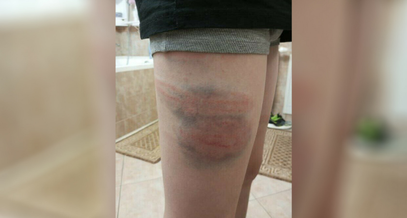 «Врач насчитал не менее пяти огромных гематом и 12 ударов» Мама калининградского мальчика, пострадавшего от рук тренера, поделилась подробностями происшествия