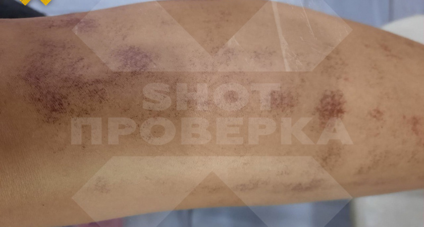 Обычная процедура по удалению волос на теле обвернулась настоящим кошмаром: что произошло на лазерной эпиляции