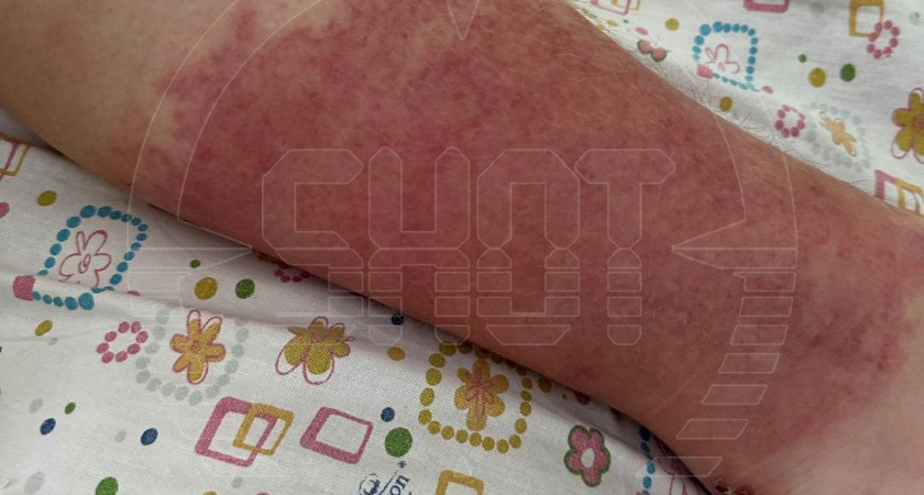 Обычная мозоль от кроссовок об вернулось страшным заболеванием для 15-летней школьницы