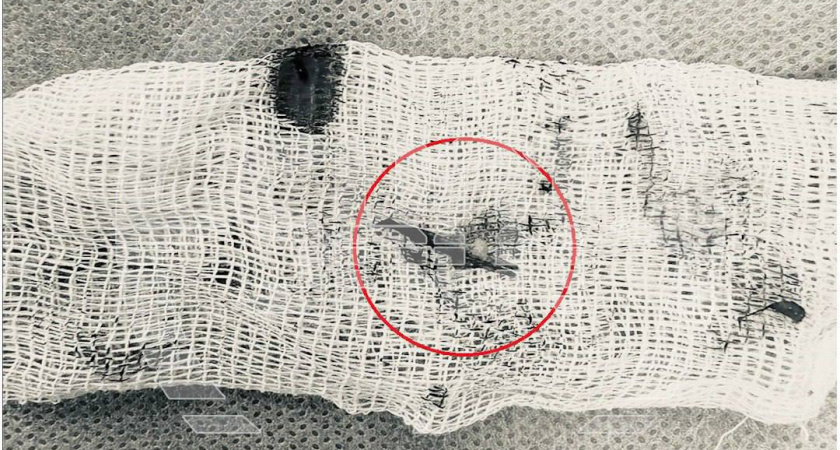 Мужчина из Подмосковья почесал в ухе и едва не умер из-за страшного воспаления