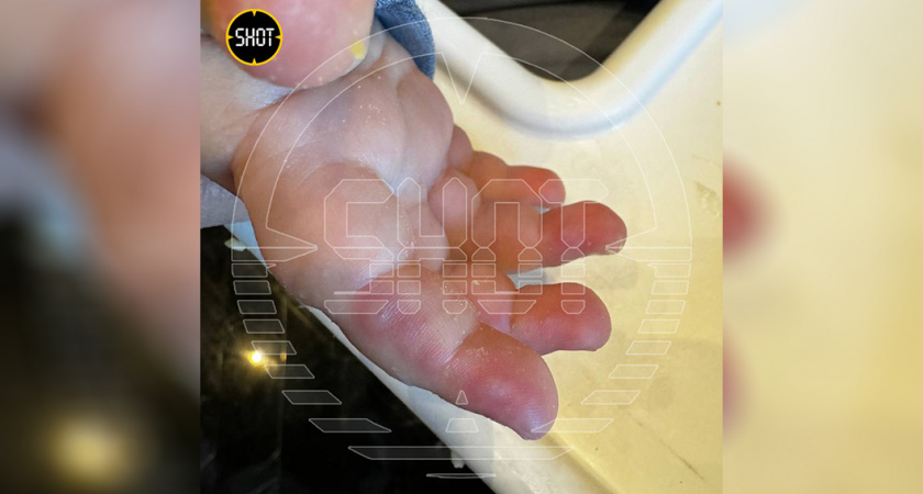 Отдых с угрозой: как после врача элитного отеля в Турции пришлось лечить опасную инфекцию у детей в России