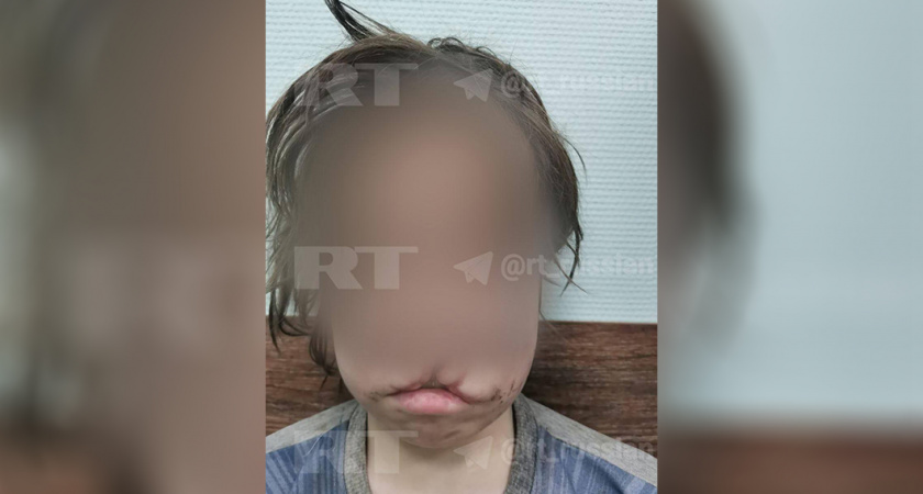 Появились новые данные о здоровье избитого отчимом 12-летнего школьника из Кемеровской области