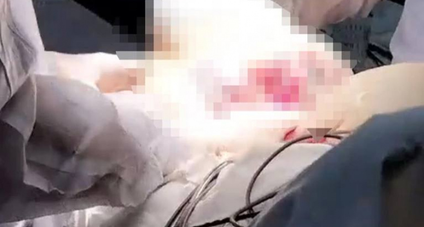 В онкоцентре Калининграда медики удалили опухоль, весом в 3 килограмма